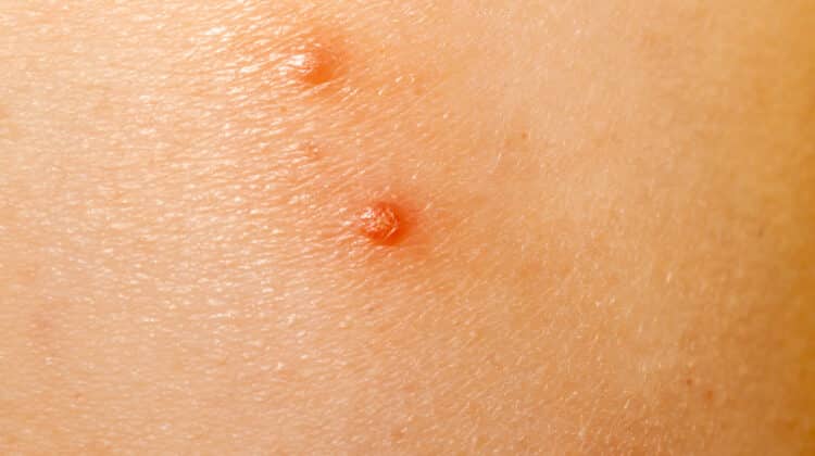 Close up of Molluscum Contagiosum also called water wart